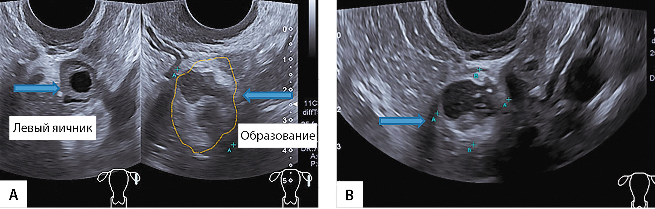 Образование округлое в яичнике. Образования яичников на УЗИ.